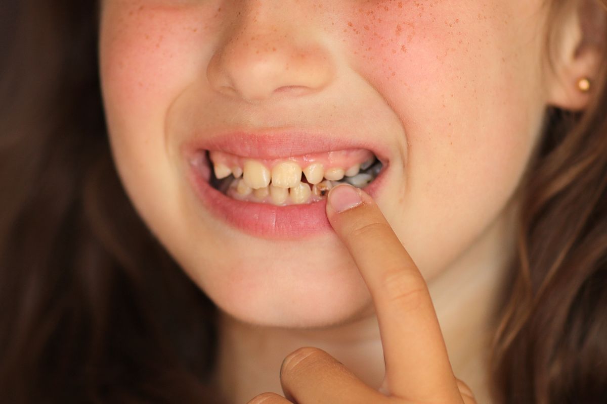 Child pointing to a tooth affected by visible decay and discoloration